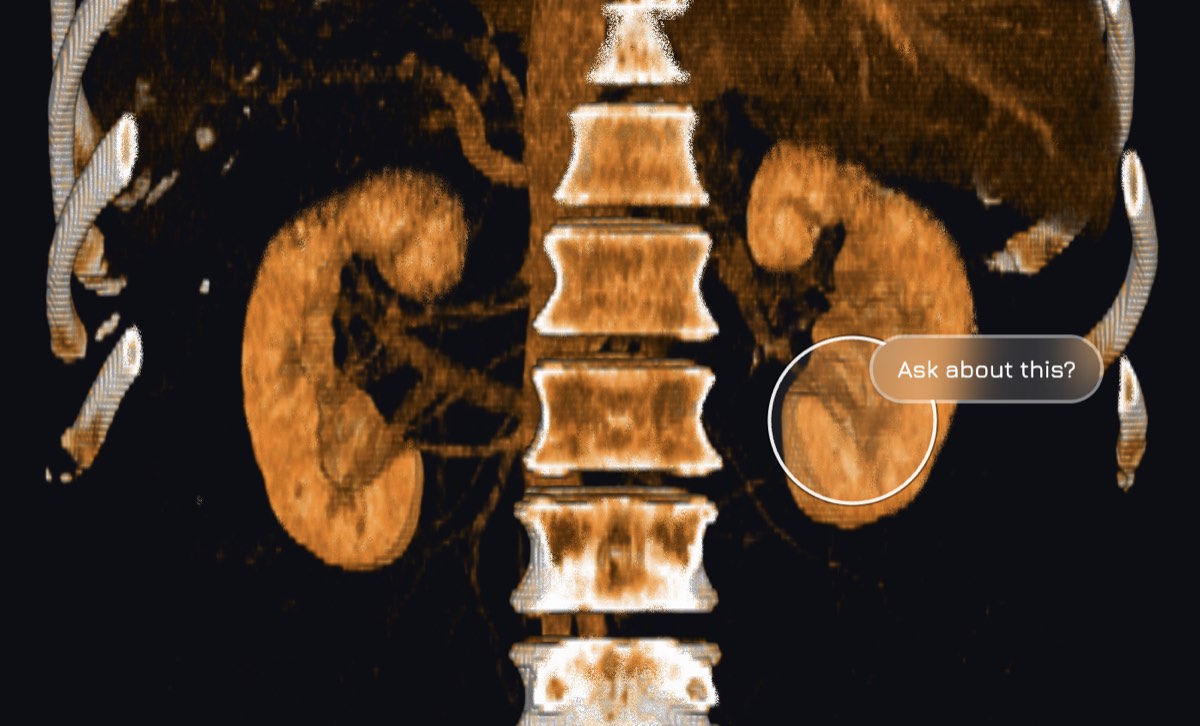 A kidney CT in KAYMO with a circle on one kidney and an 'Ask about this?' prompt
